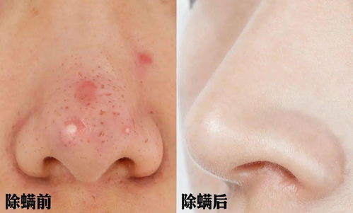 长痘痘表情包搞笑图片抖