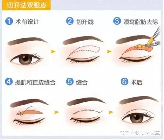 割双眼皮对外貌的改变大吗 割双眼皮对外貌的改变大吗