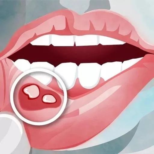 口腔溃疡就是上火这些误区别再犯了 口腔溃疡就是上火这些误区别再犯了