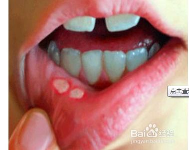 得了口腔溃疡很难受怎么办 得了口腔溃疡很难受怎么办