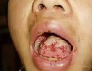 口腔溃疡一次治愈太神奇了 口腔溃疡一次治愈太神奇了