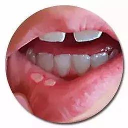 口腔溃疡难受表情包