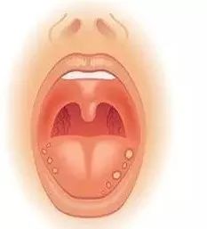 口腔溃疡到底有多疼口腔科医生带来了一堆干货给你 口腔溃疡到底有多疼口腔科医生带来了一堆干货给你