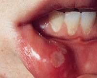 10个小方法预防口腔溃疡 10个小方法预防口腔溃疡