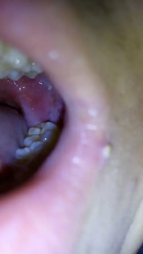 口腔问题,口腔里有个黄色的凹坑,和一个白色的包,是什么口腔病 口腔问题,口腔里有个黄色的凹坑,和一个白色的包,是什么口腔病