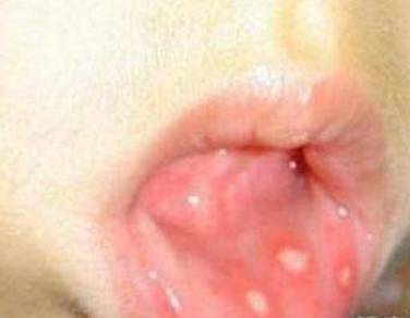 口腔溃疡很难受,这6个快速治愈的方法你不得不知道 口腔溃疡很难受,这6个快速治愈的方法你不得不知道