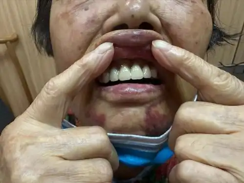 83岁老太口腔医院做假牙,没想到一口牙被全拔光,女儿质疑母亲掉陷阱 83岁老太口腔医院做假牙,没想到一口牙被全拔光,女儿质疑母亲掉陷阱